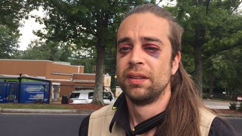 Ryan Sunderland suffered bruises from an attack Saturday in Sandy Springs. (Credit: Channel 2 Action News)