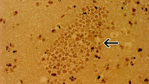 A section of the brain from a PAM patient stained with hemotoxylin and eosin showing a large cluster of Naegleria fowleri trophozoites surrounding capillaries. (CDC photo)