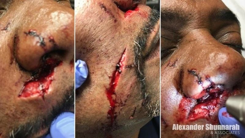 These are the face wounds of Marlin Jackson, an Alabama man attacked by an emotional service dog on a Delta Air Lines flight in June 2017. Source: Alexander Shunnarah & Associates