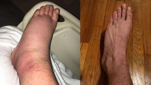 Paul Sweatman’s foot swelled up with a mystery bacterial infection in the fall of 2017, and an urgent care clinic told him to get to the emergency room. The hospital treated him for three days and the foot did not have to be amputated. But days later the swelling returned, and he rushed back to the ER. Anthem/Blue Cross said the second visit was not an emergency and refused to pay. These photos show the foot during Sweatman’s first trip to the hospital, and as it usually is, this week. (Photos courtesy of Paul Sweatman)