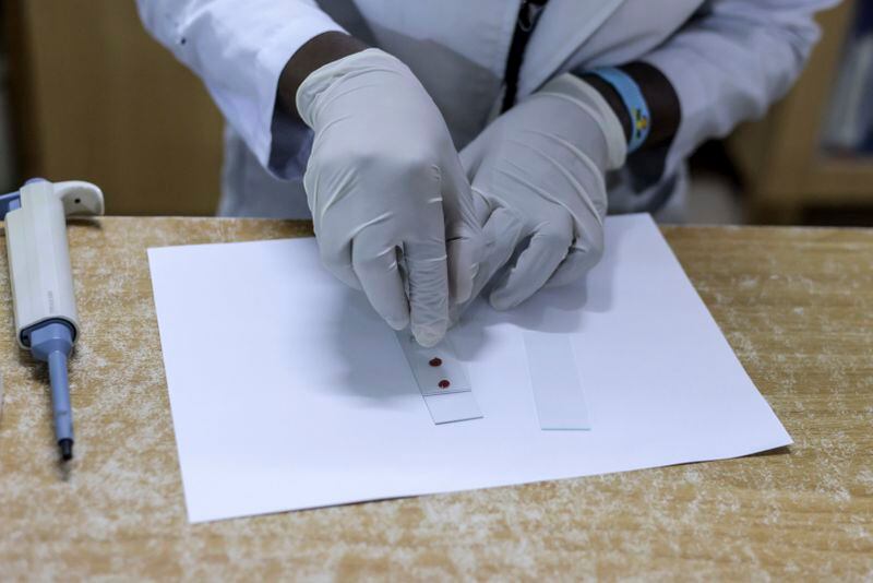 A laboratory technician holds malaria blood test slides at the Nightingale Medical Centre, in Kisumu, Kenya Tuesday, April. 16, 2024. Even after parts of Kenya participated in an important pilot of the world's first malaria vaccine, with a reported drop in deaths for children under 5, the disease is still a significant public health challenge. Kenya's health ministry hasn't said when the vaccine will be widely available. (AP Photo/Brian Ongoro)