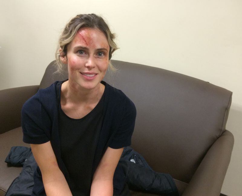 Anna Hutchison in cosmetically applied injuries. Photo: Jennifer Brett