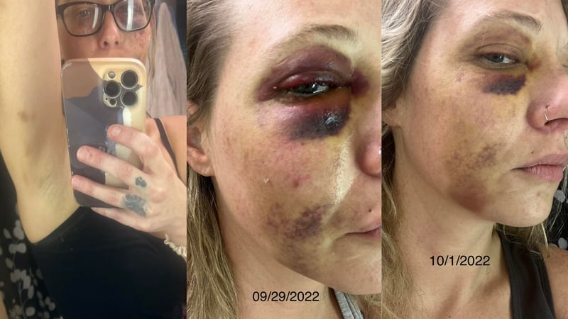 Annie Lloyd sent pictures to the AJC of her injuries after the incident.