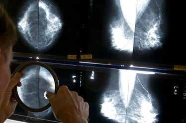 A radiologist uses a magnifying glass to check mammograms for breast cancer in Los Angeles, May 6, 2010. June 2 is National Cancer Survivor Day. (AP Photo/Damian Dovarganes, File)