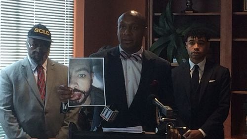 Attorney Mawuli Davis holds a photo of client Corey Toole’s injuries. Toole is suing the city of Atlanta and police officers, accusing them of forcibly throwing him to the ground and unlawfully arresting him. (RAISA HABERSHAM / RAISA.HABERSHAM@AJC.COM)