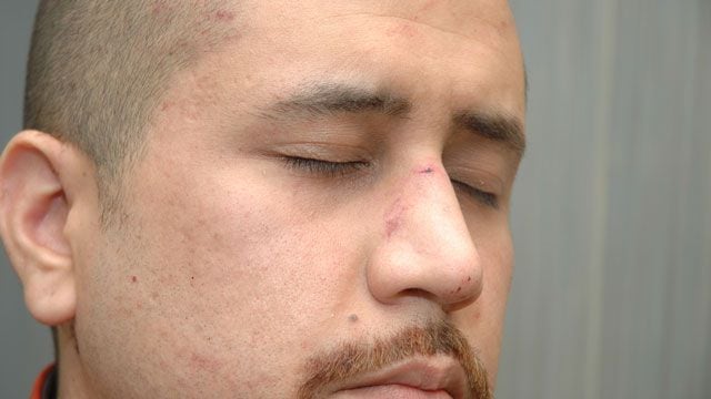 Photo: Zimmerman bloodied after Martin shooting