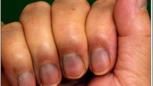 Federal authorities say that ingesting colloidal silver can cause a condition known as argria, where the skin and nail become discolored a blue gray because of excess silver ions in the body. Photo from National Library of Medicine
