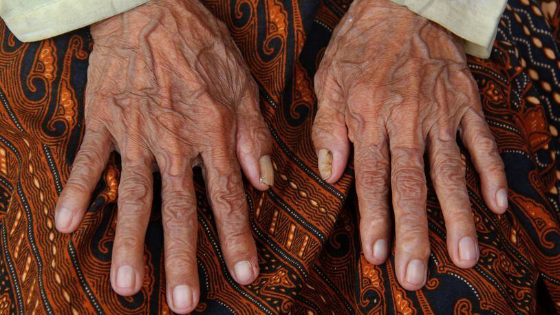 PURWAKARTA, INDONESIA - MAY 15: Anami shows her wrinkled fingers May 15, 2015 in Purwakarta, Indonesia. According to members of her family, Anami is believed to be 140 years old and is set to be put through a thorough medical examination as part of the World's Oldest Woman contest in Russia. Anami has had to meet with the District Head of Purwakarta to request his support to attend the competition in which the winner will receive Rp 13 billion. The world's current oldest known living person is 115-year-old Jeralean Talley of the U.S. (Photo by Nurcholis Anhari Lubis/Getty Images)