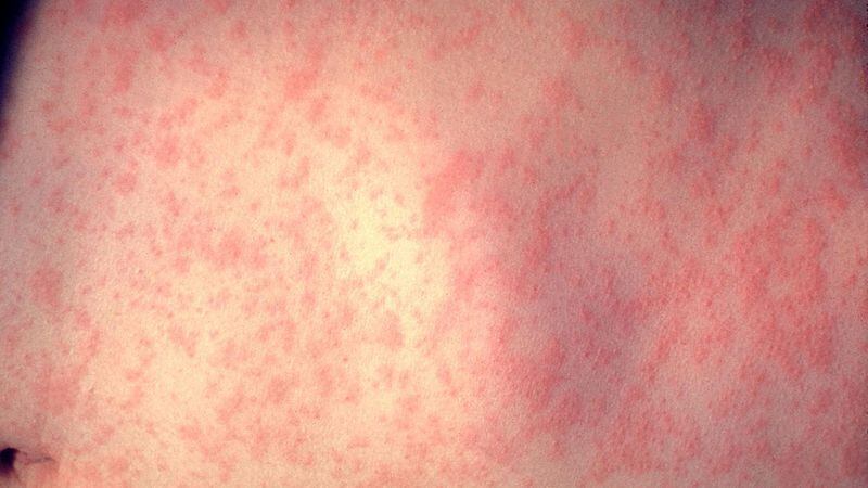 Health experts are warning that people who were vaccinated for the measles before 1989 may need a booster shot.