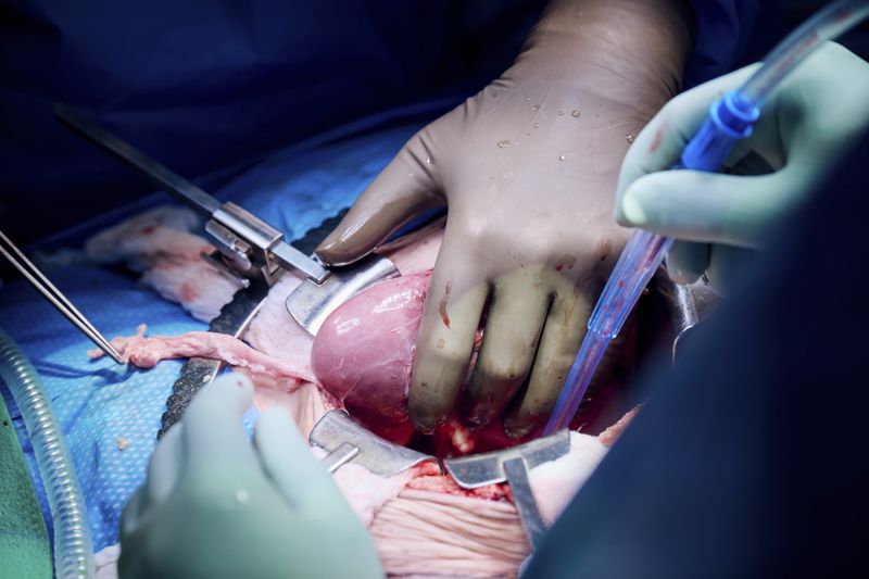 In this photo provided by NYU Langone Health, a surgeon lifts the gene-edited pig kidney out of Lisa Pisano's abdomen to check its function at the hospital in New York on April 12, 2024. Doctors transplanted the organ into Pisano, who was near death, part of a dramatic pair of surgeries that also included a fix for her failing heart. (Joe Carrotta/NYU Langone Health via AP)