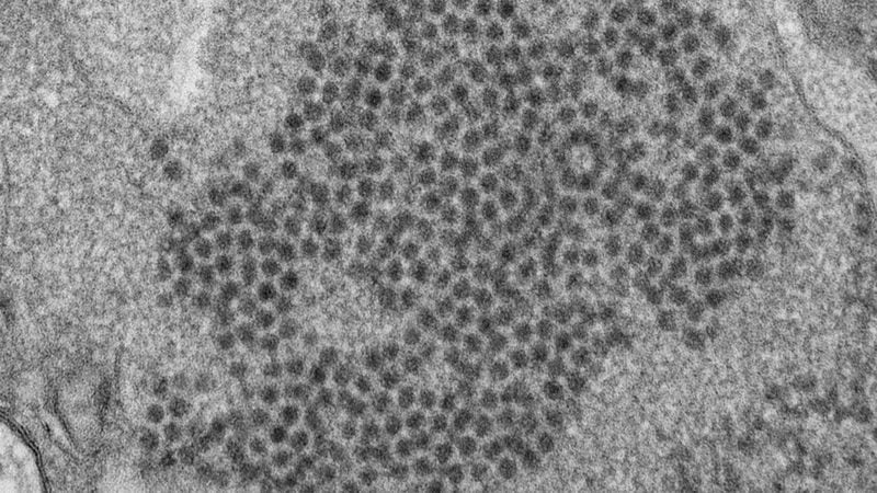 This 2014 electron microscope image made available by the Centers for Disease Control and Prevention shows numerous, spheroid-shaped Enterovirus-D68 (EV-D68) virions. Doctors have suspected a mysterious paralyzing illness, acute flaccid myelitis, might be tied to a kind of enterovirus, such as EV-D68 or EV-A71. A spike in EV-D68 illnesses coincided with the first mysterious wave of paralysis cases in 2014.