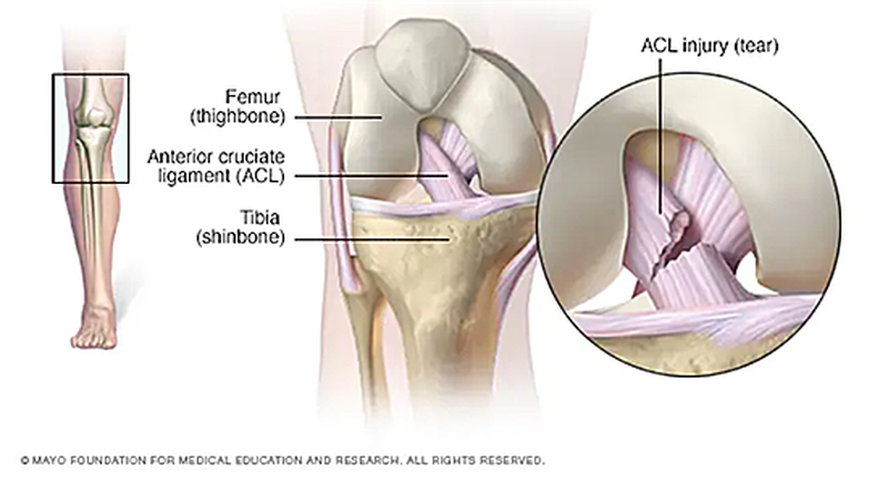 The Anterior Cruciate Ligament — one of two ligaments that crosses the middle of the knee — connects your thighbone (femur) to your shinbone (tibia) and helps stabilize your knee joint. According to the Mayo Clinic, most ACL injuries happen during sports and fitness activities that can put stress on the knee, including: suddenly slowing down and changing direction (cutting), pivoting with your foot firmly planted, landing from a jump incorrectly, stopping suddenly, and receiving a direct blow to the knee. The MCL, or the Medial Collateral Ligament is the wide, thick band of tissue that runs down the inner part of the knee from the thighbone (femur) to a point on the shinbone (tibia), which is behind the ACL and about 4 to 6 inches from the knee.