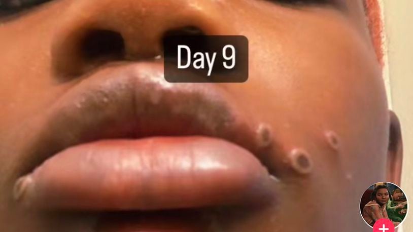 Camille Seaton, a 20-year-old from Marietta, turned to social media to share her experience with monkeypox. The Georgia Department of Public Health confirmed its first case of monkeypox in a female in late July 2022. (TikTok screenshots)
