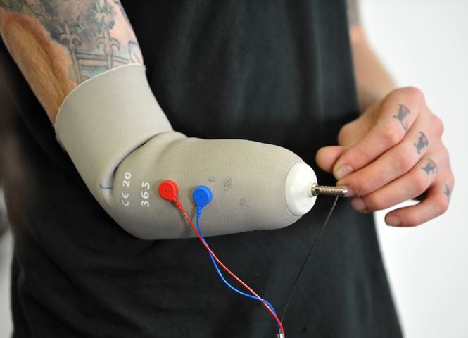 Jason Barnes and the robotic prosthesis