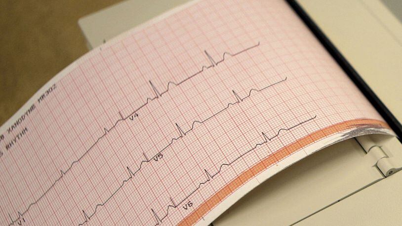 A printout from an electrocardiogram machine, which measures heart activity. (AP Photo/Jeff Roberson)