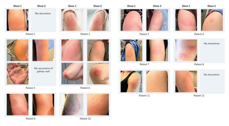A series of photos combined into one image, provided by the New England Journal of Medicine, shows delayed skin reactions in various patients after receiving the mRNA COVID-19 vaccines. (New England Journal of Medicine via The New York Times)