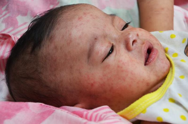 Measles is a highly contagious respiratory disease caused by the measles virus. The disease is also called rubeola. Measles causes fever, runny nose, cough and a rash all over the body. About one out of 10 children with measles also gets an ear infection, and up to one out of 20 gets pneumonia. For every 1,000 children who get measles, one or two will die. Adults can also get measles especially if they are not vaccinated. Children under 5 years of age and adults over 20 are at higher risk for measles complications including pneumonia, and a higher risk of hospitalization and death from measles than school aged children and adolescents. (CDC)
