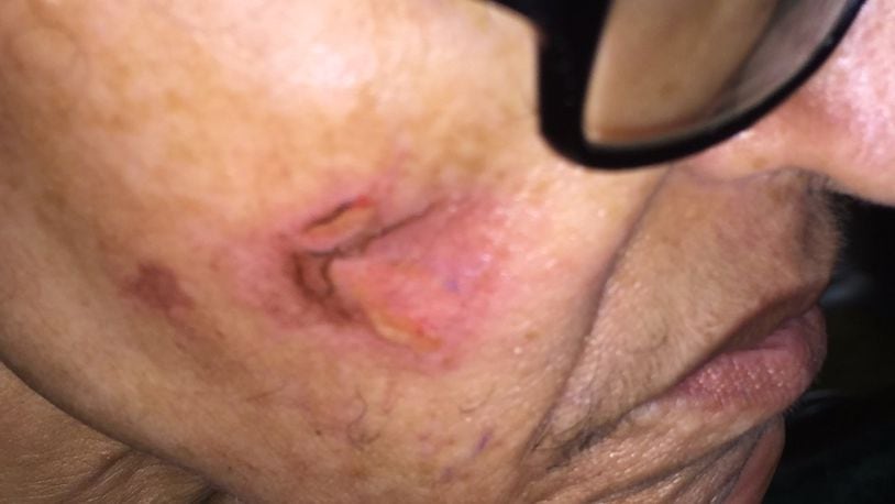 This is a picture of the burn on the face of Jacquelyn Stafford, a dementia patient who was spending a week at Hapeville Manor. In a lawsuit, her family alleges that a caregiver burned her repeatedly with a cigarette.