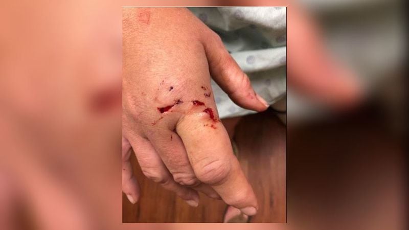 DeDe Phillips is being treated for rabies at Northeast Georgia Medical Center after a bobcat attack. She also sustained bite and claw wounds to her hands, arms, chest and legs. (Credit: Athens Banner-Herald)