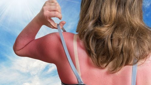 A photo illustration shows just how potentially painful sunburns can be, but there are steps you can take to take the edge off. (Dreamstime/TNS)