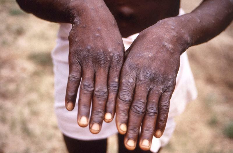 FILE - This 1997 image provided by the CDC during an investigation into an outbreak of monkeypox, which took place in the Democratic Republic of the Congo (DRC), formerly Zaire, depicts the dorsal surfaces of the hands of a monkeypox case patient. Scientists say a new form of mpox detected in a mining town in Congo might more easily spread among people. Already, Congo is seeing its biggest mpox outbreak with more than 19,000 suspected infections and 900 deaths (CDC via AP, File)