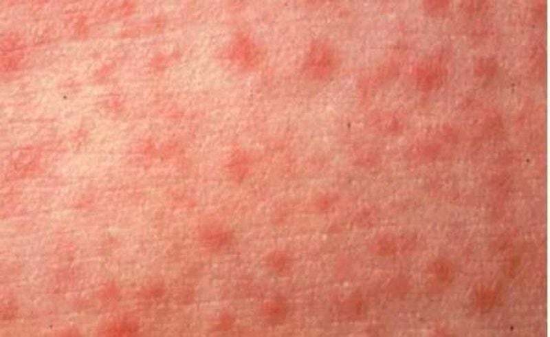 File photo of a measles rash