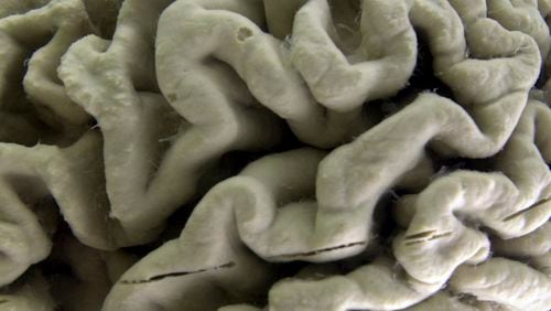 FILE - A section of a human brain with Alzheimer's disease is displayed at the Museum of Neuroanatomy at the University at Buffalo, in Buffalo, N.Y., Oct. 7, 2003. A long-feared gene appears to do more than raise people’s risk of Alzheimer’s: Inheriting two copies can cause the mind-robbing disease, according to research published in the journal Nature Medicine on Monday, May 6, 2024. (AP Photo/David Duprey, File)