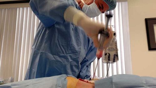 Dr. Mark Berman, of the California-based Cell Surgical Network, collects fat from a patient’s back as  part of an experimental stem cell procedure. Berman is one of the defendants in a lawsuit filed by Doris Tyler, of Florida, who claims she went blind from a procedure done by a Georgia clinic that’s part of his network. Berman’s company is one of many for-profit clinics that market stem cells to patients to treat dozens of different diseases and conditions.