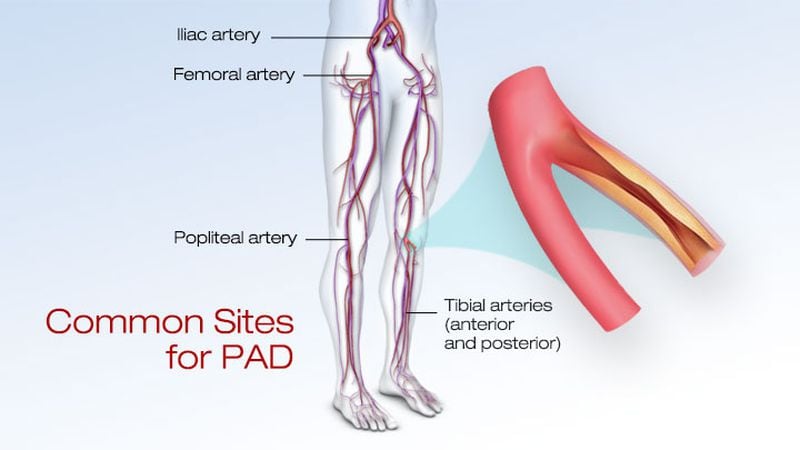 PAD graphic, provided by the American Heart Association, metro Atlanta chapter