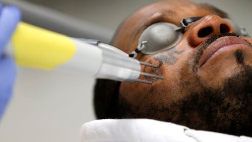 Charles Greene has his second of nine treatments to remove a tattoo from his cheek by Chuck Powell of East Coast Laser Tattoo Removal in Henrico, Va. (Mark Gormus/Richmond Times-Dispatch via AP)