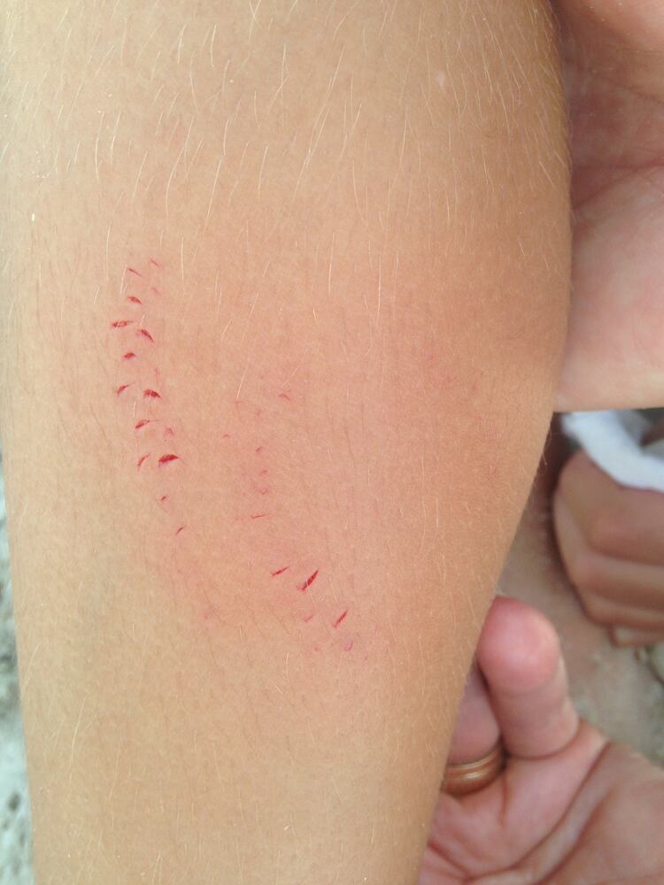 GRAPHIC WARNING: Shark bite at St. Helena Island
