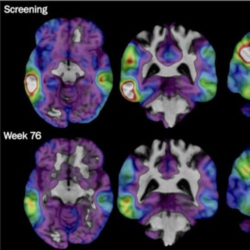 These brain scan images provided by Biogen show how high levels of Alzheimer's-related tau protein, in red, dropped in a recipient of the company's experimental drug diranersen. (Biogen via AP)