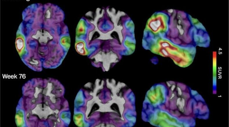 These brain scan images provided by Biogen show how high levels of Alzheimer's-related tau protein, in red, dropped in a recipient of the company's experimental drug diranersen. (Biogen via AP)