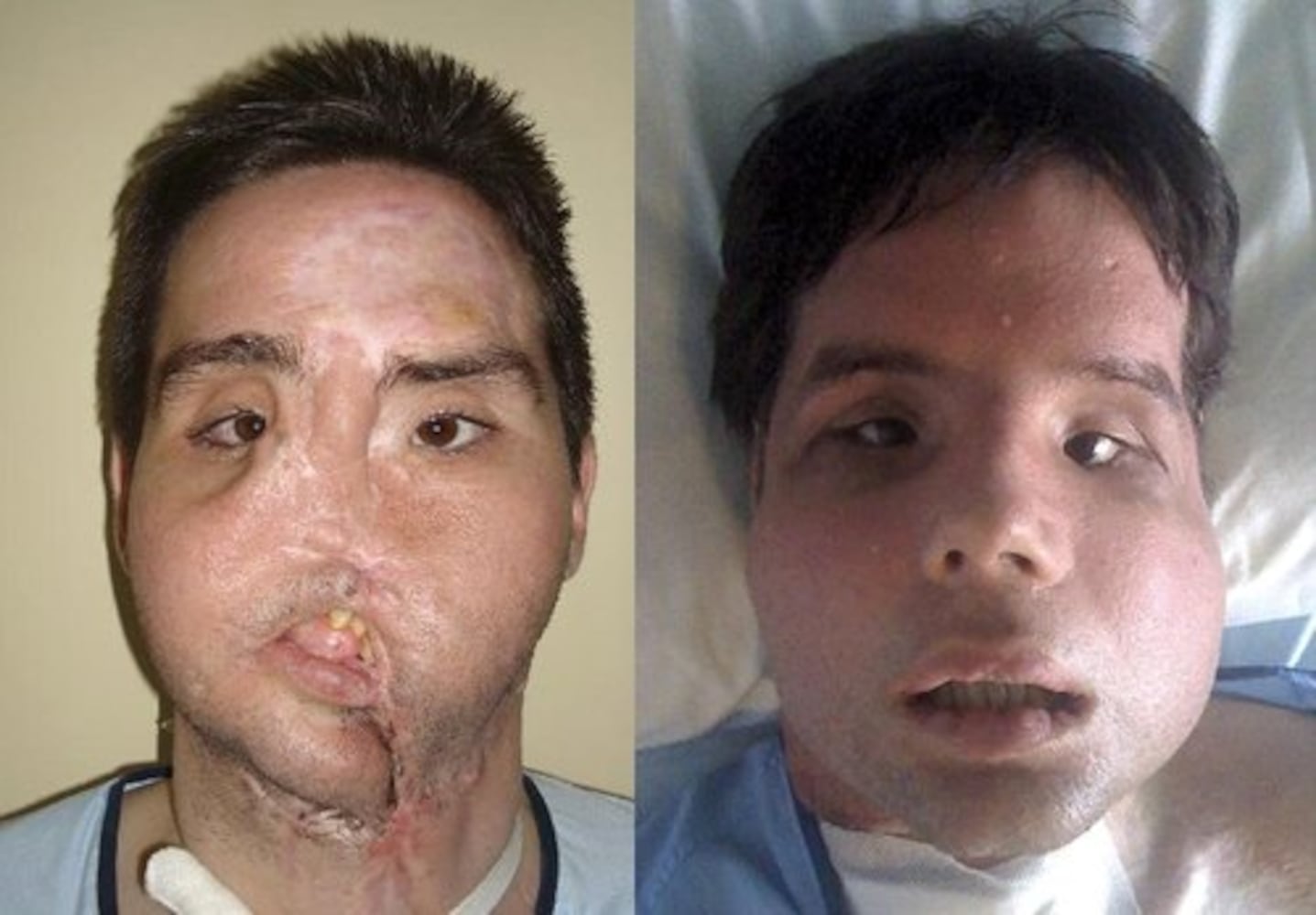 Spain's face transplant success stories