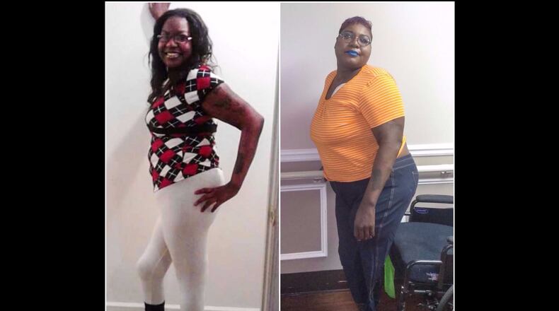 Nikosha Robertson before and after losing her leg.