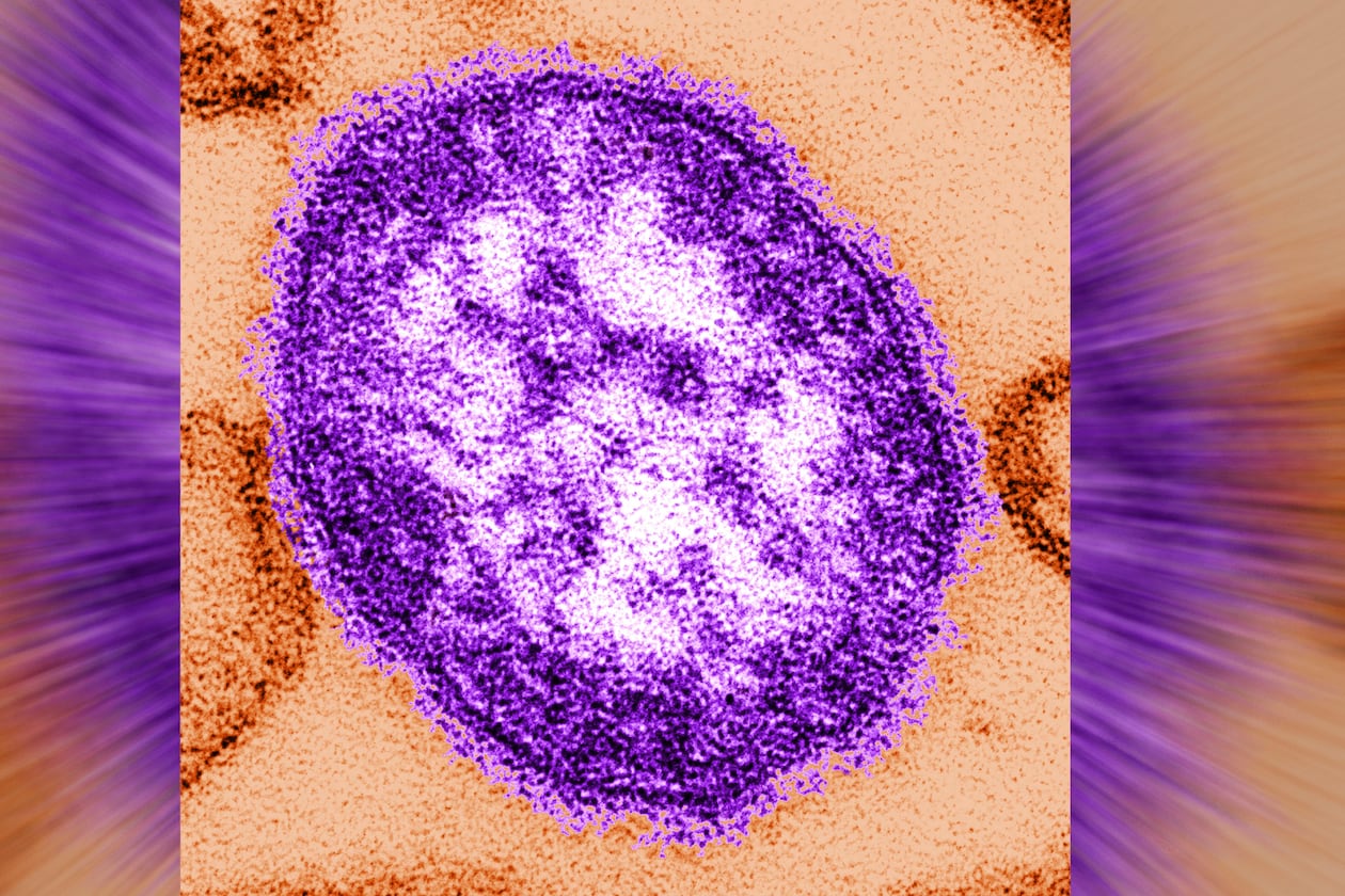 An electron microscope image of a measles virus particle. (Cynthia Goldsmith/Centers for Disease Control and Prevention via AP FILE)