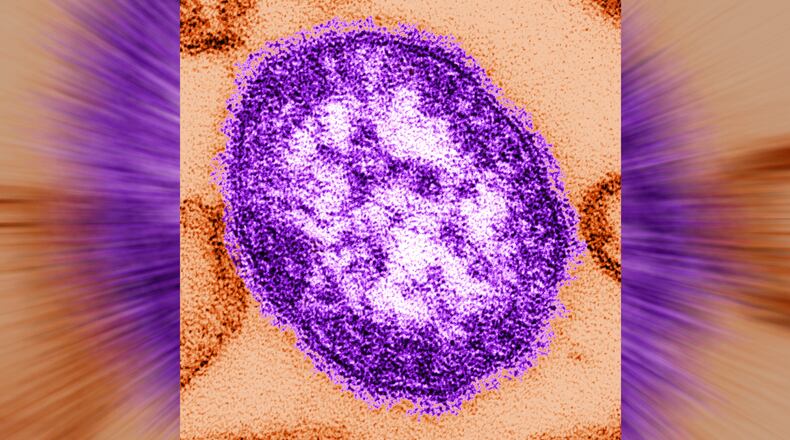 An electron microscope image of a measles virus particle. (Cynthia Goldsmith/Centers for Disease Control and Prevention via AP, File)