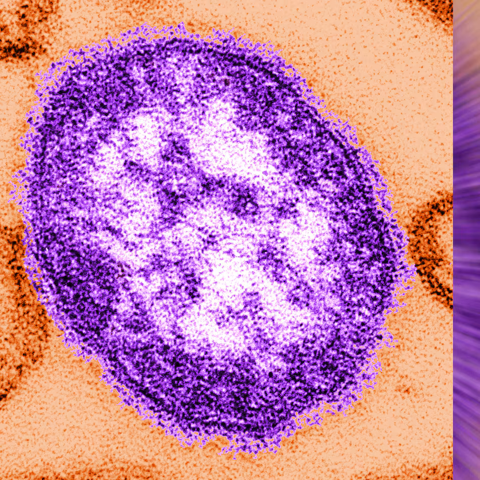 An electron microscope image of a measles virus particle. (Cynthia Goldsmith/Centers for Disease Control and Prevention via AP)