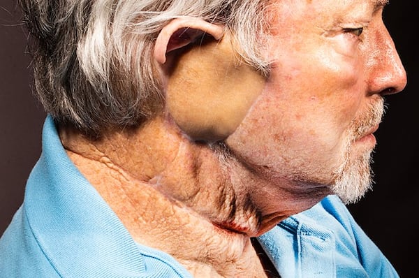 Tony Waldrop, of North Georgia, had surgery in 2014 to remove skin cancer. This image is part of a civil case against Waldrop's dermatologist in Atlanta, in which Waldrop's widow was awarded $56 million. (Courtesy)