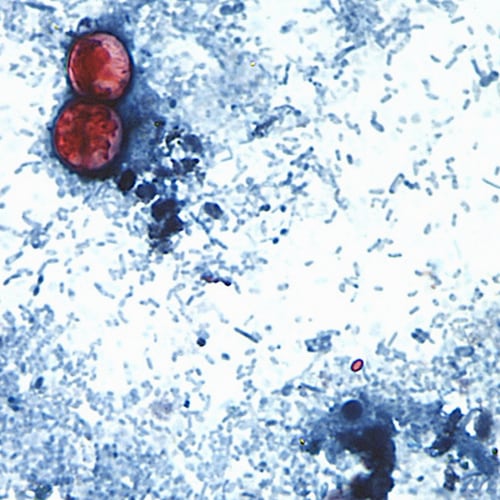 FILE - This undated photo taken through a microscope provided by the CDC shows Cyclospora cayetanensis oocysts found in a fresh stool sample which had been prepared with a formalin solution and stained with safranin. (CDC via AP, File)