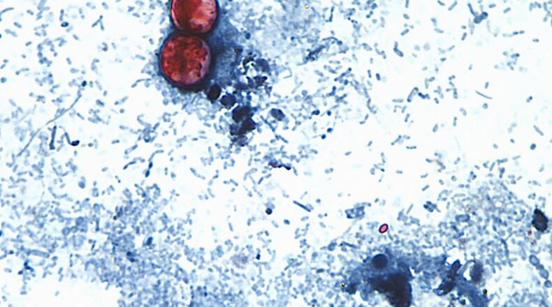 FILE - This undated photo taken through a microscope provided by the CDC shows Cyclospora cayetanensis oocysts found in a fresh stool sample which had been prepared with a formalin solution and stained with safranin. (CDC via AP, File)