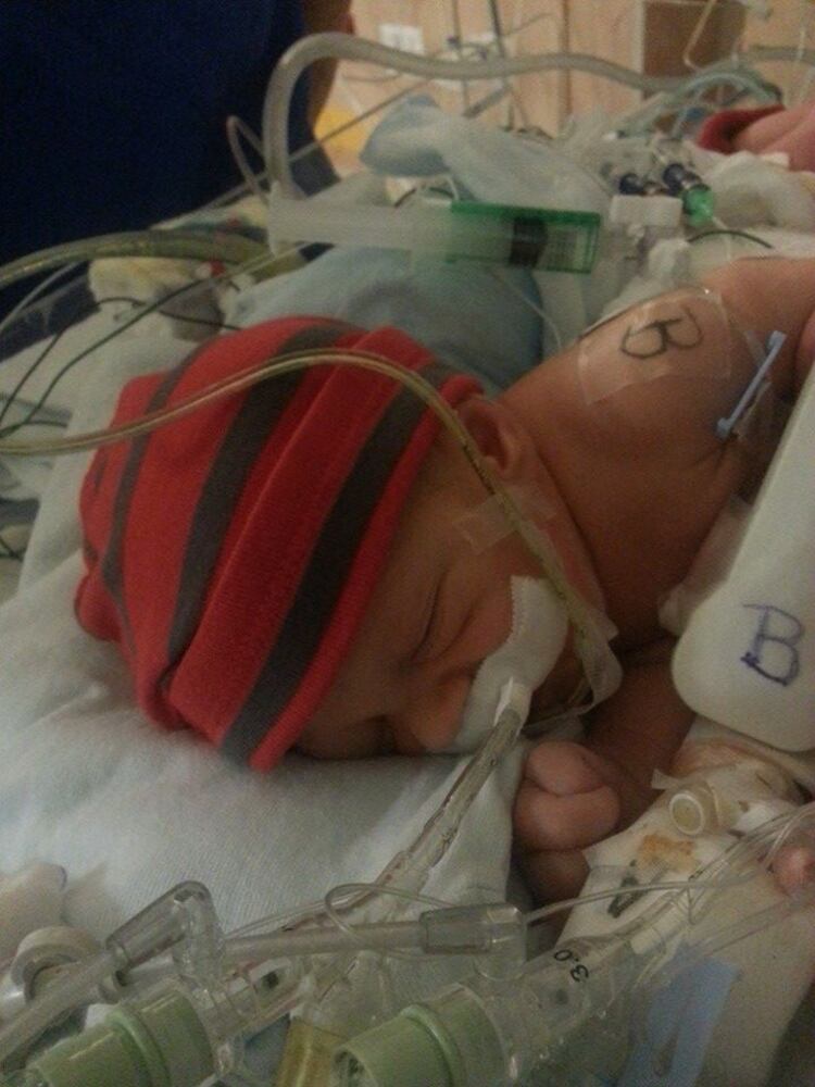 Conjoined twins born in Jacksonville