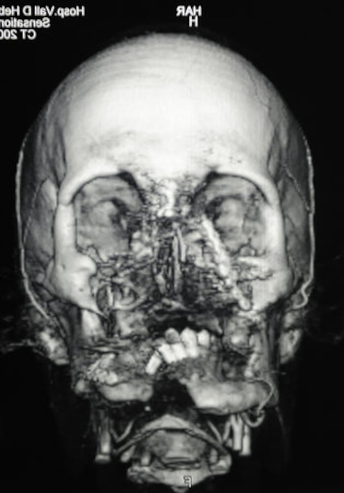 Spain's face transplant success stories
