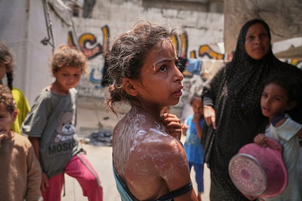 Rital Abu Jari, 9, stands after receiving cream to relieve burns on her back and shoulder, which she suffered while trying to get warm donated food at a community kitchen in Gaza City, Tuesday, June 10, 2025. (AP Photo/Jehad Alshrafi)