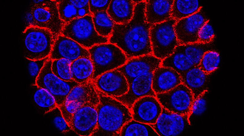 FILE - This undated microscope image from USC via the NIH shows pancreatic cancer cells, nuclei in blue, growing as a sphere encased in membranes, red. (Min Yu/Eli and Edythe Broad Center for Regenerative Medicine and Stem Cell Research at USC, USC Norris Comprehensive Cancer Center, File)