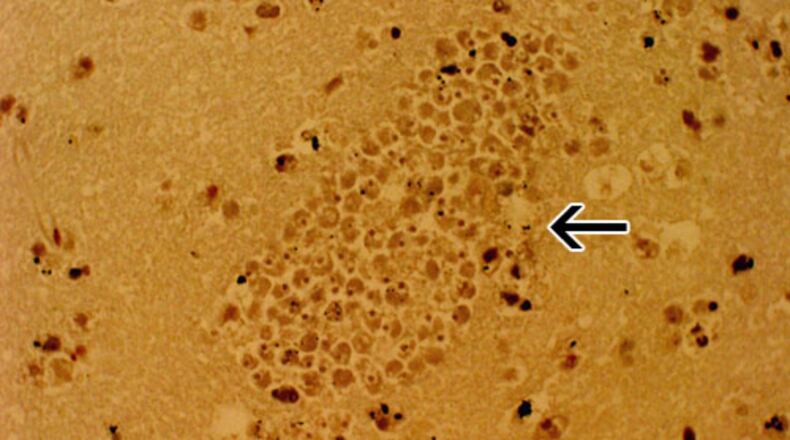 A section of the brain from a PAM patient stained with hemotoxylin and eosin showing a large cluster of Naegleria fowleri trophozoites surrounding capillaries. (CDC photo)