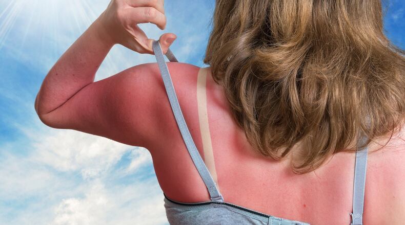 A photo illustration shows just how potentially painful sunburns can be, but there are steps you can take to take the edge off. (Dreamstime/TNS)