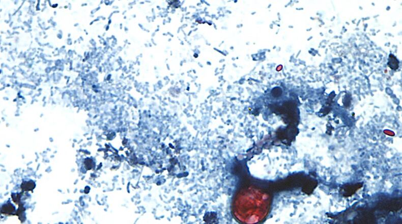 This undated photo taken through a microscope provided by the CDC shows Cyclospora cayetanensis oocysts found in a fresh stool sample which had been prepared with a formalin solution and stained with safranin. (CDC via AP)