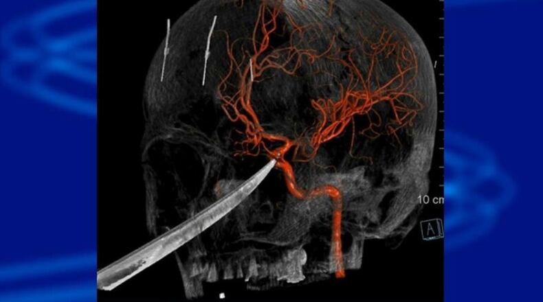 This 3D computer graphic model made from X-ray imagery shows how a tip of the knife stopped against the carotid artery of 15-year-old Eli Gregg.