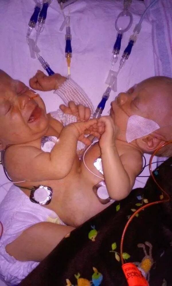 Conjoined twins Carter and Conner